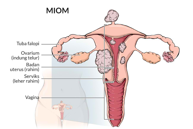 pengertian mioma uteri